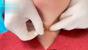 环甲肌体表定位及针刀实操视频封面