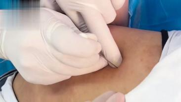 肩胛提肌针刀实操视频封面