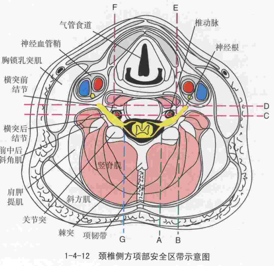 颈椎侧方项部安全区带示意图