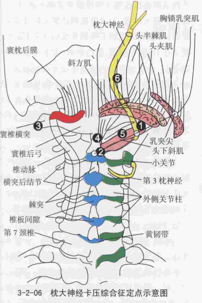枕大神经卡压综合征定点示意图