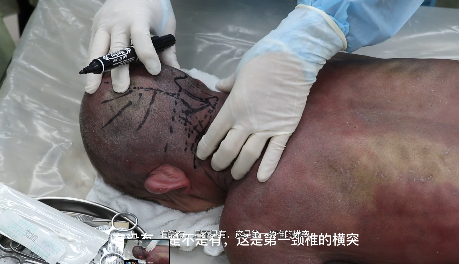 后颈部相关疾病的思路及进针技巧视频封面