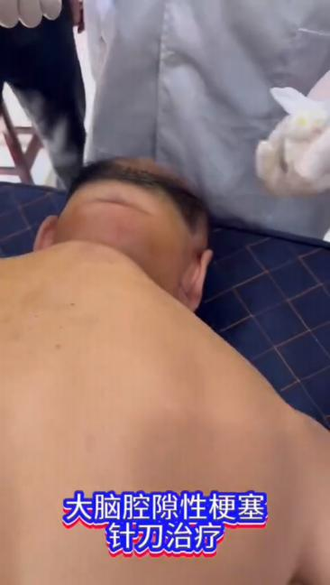大脑腔隙性梗塞针刀治疗视频封面