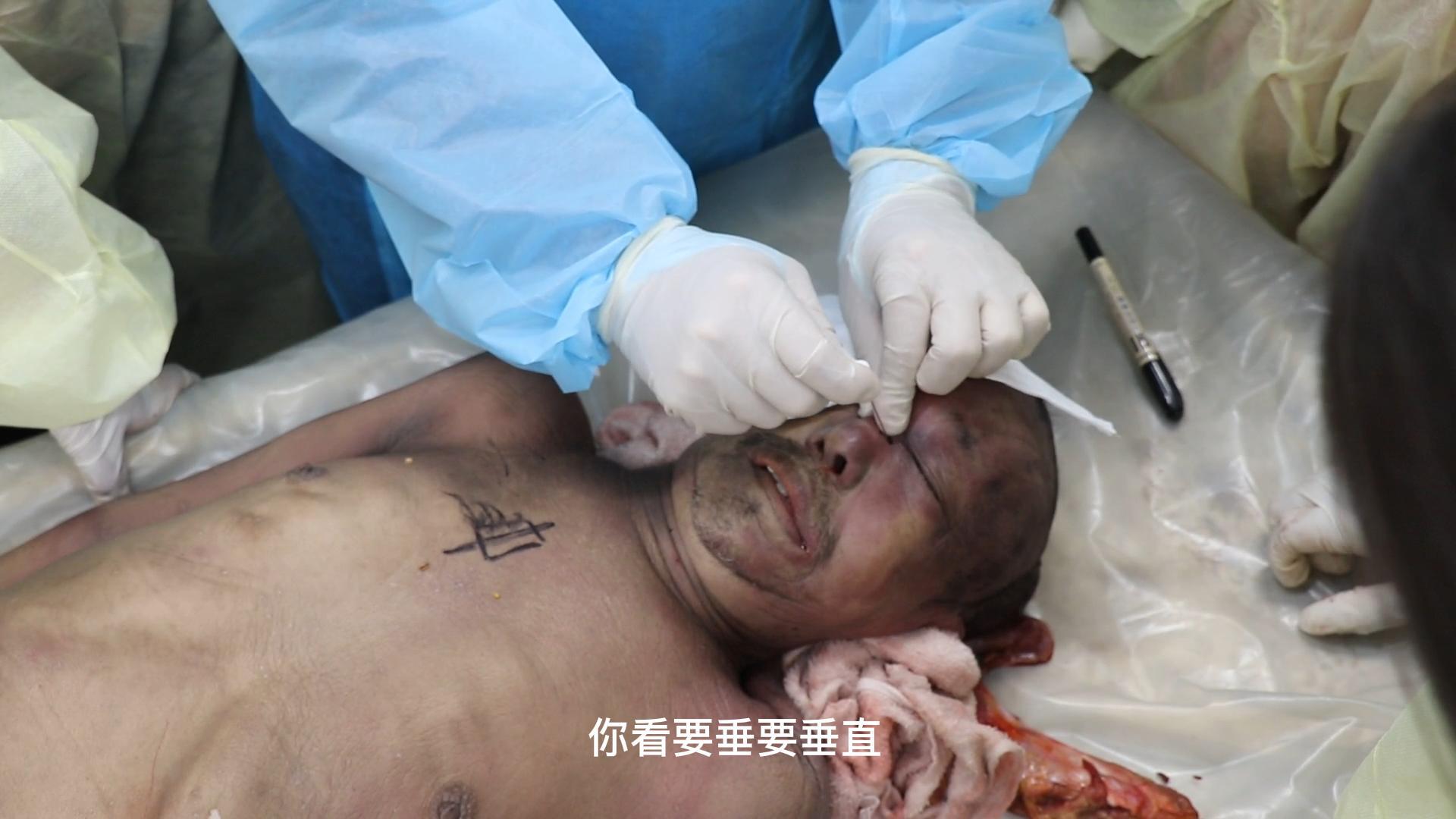 头面部相关疾病及进针技巧视频封面