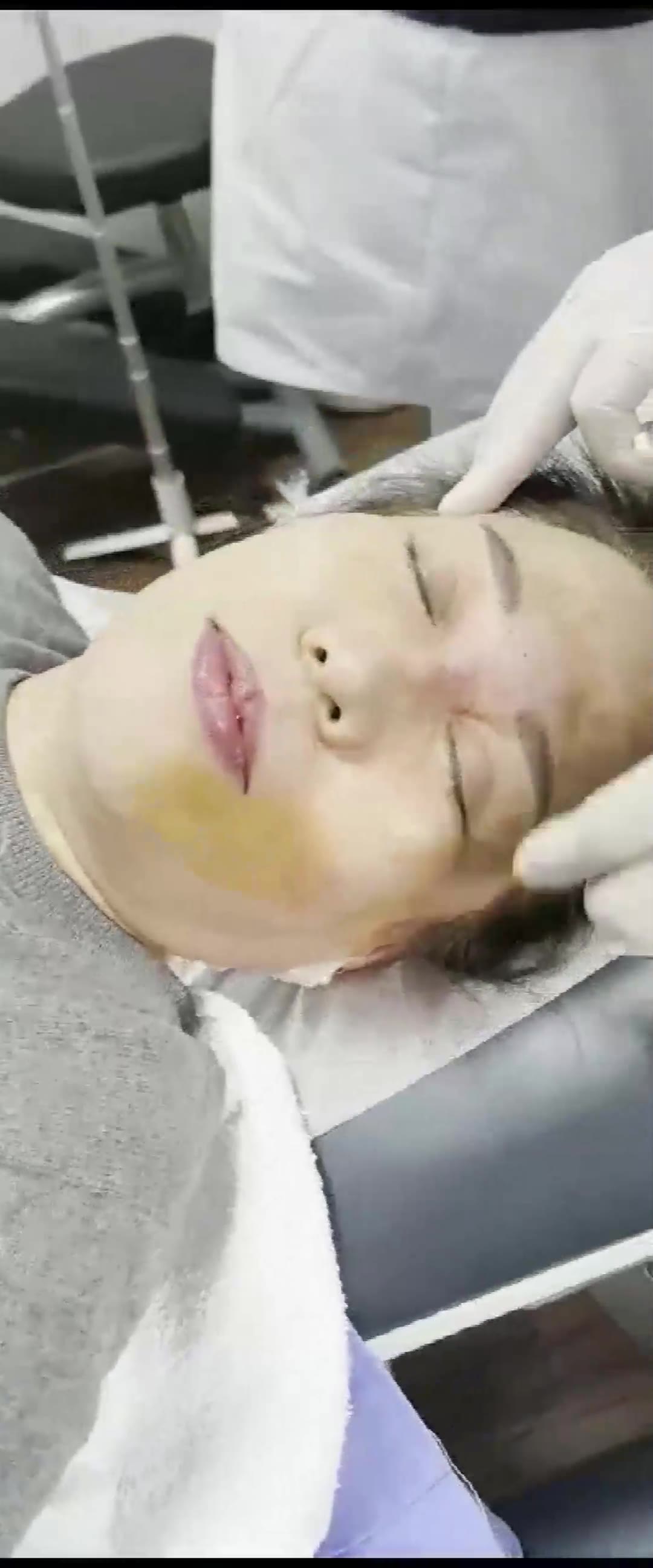 局麻下针刀美容视频封面