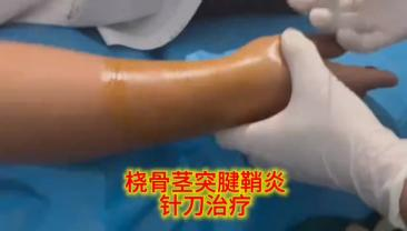 桡骨茎突狭窄性腱鞘炎针刀治疗视频封面