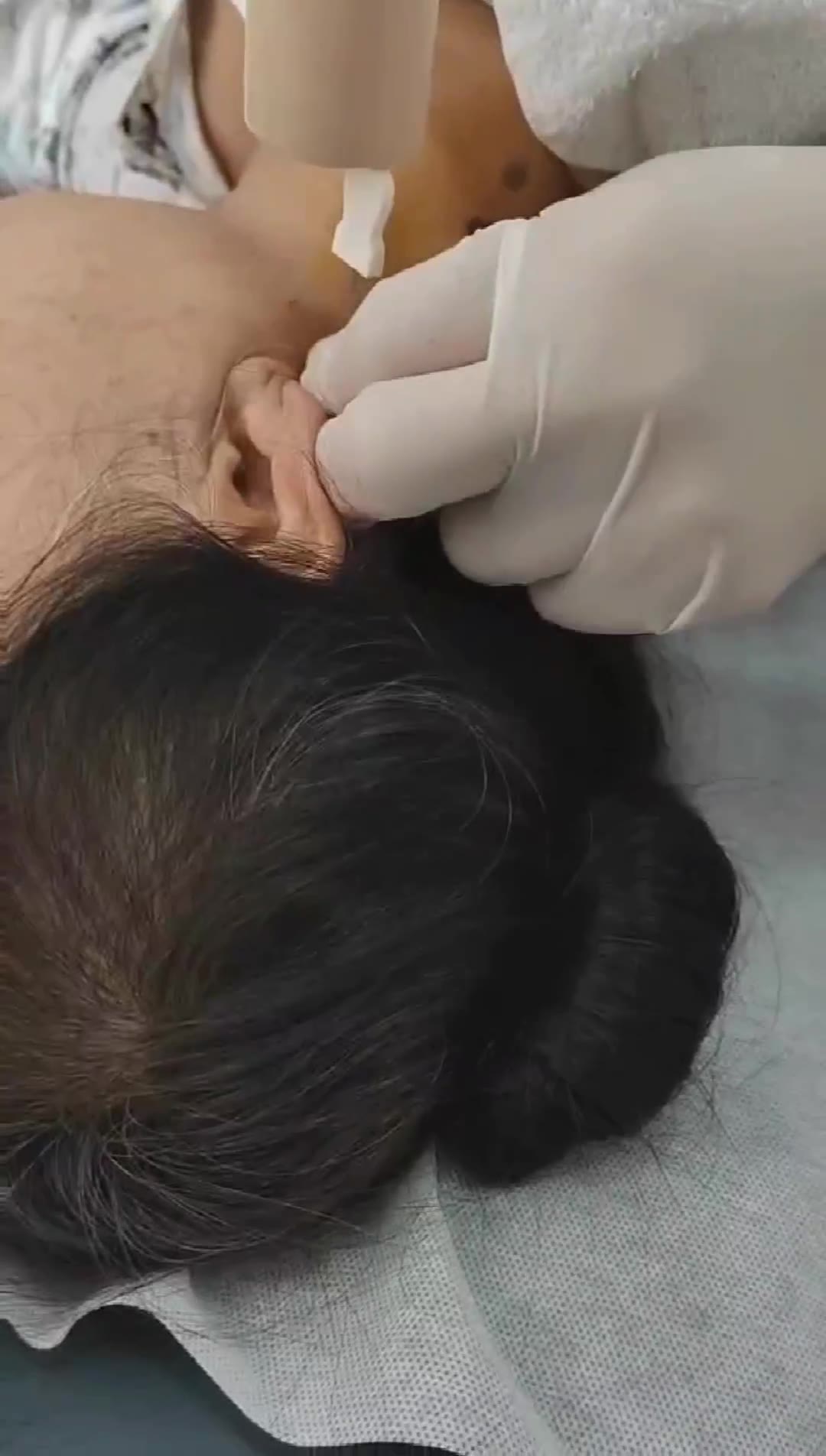 治疗三叉神经痛（二诊）视频封面