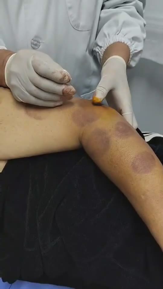 治疗上肢麻痛视频封面