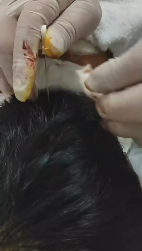 治疗偏头痛视频封面