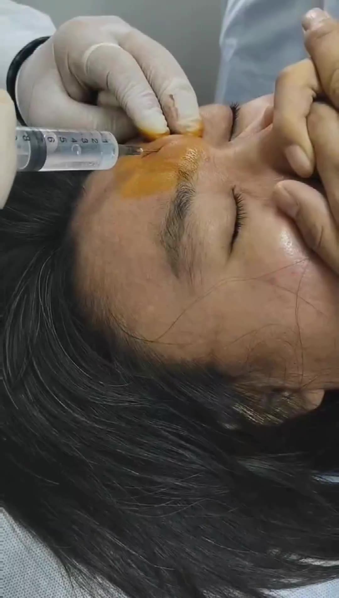 治疗川字纹视频封面