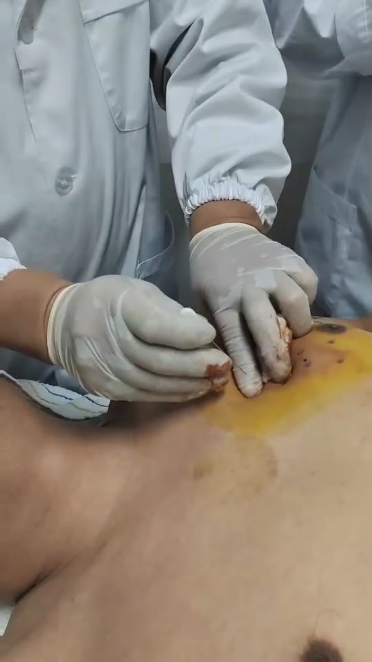 治疗心绞痛_2视频封面