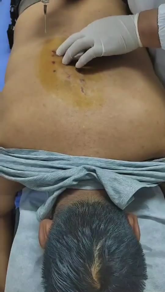 治疗糖尿病视频封面