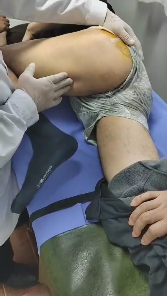 治疗股骨头坏死视频封面