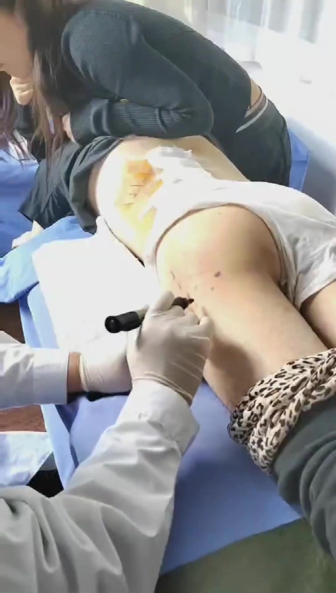 治疗股骨头坏死（4诊）视频封面