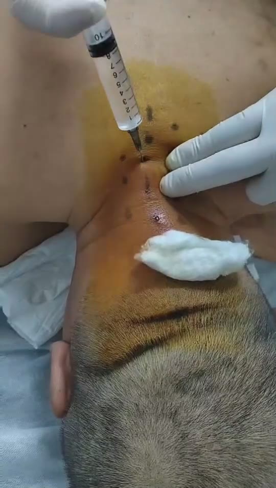 治疗肩甲骨内侧疼痛视频封面