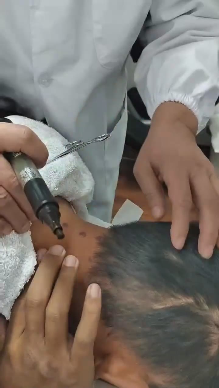 治疗脑积水视频封面