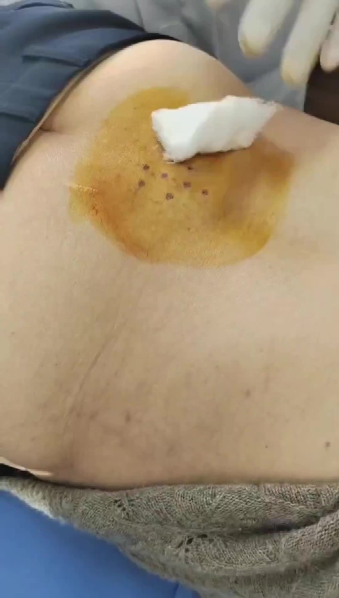 治疗腰椎管狭窄视频封面