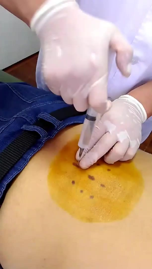 治疗腰痛、双臀酸胀视频封面