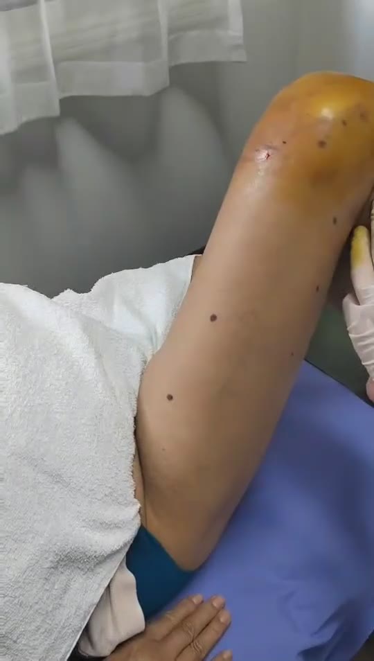 治疗膝关节外侧疼痛视频封面