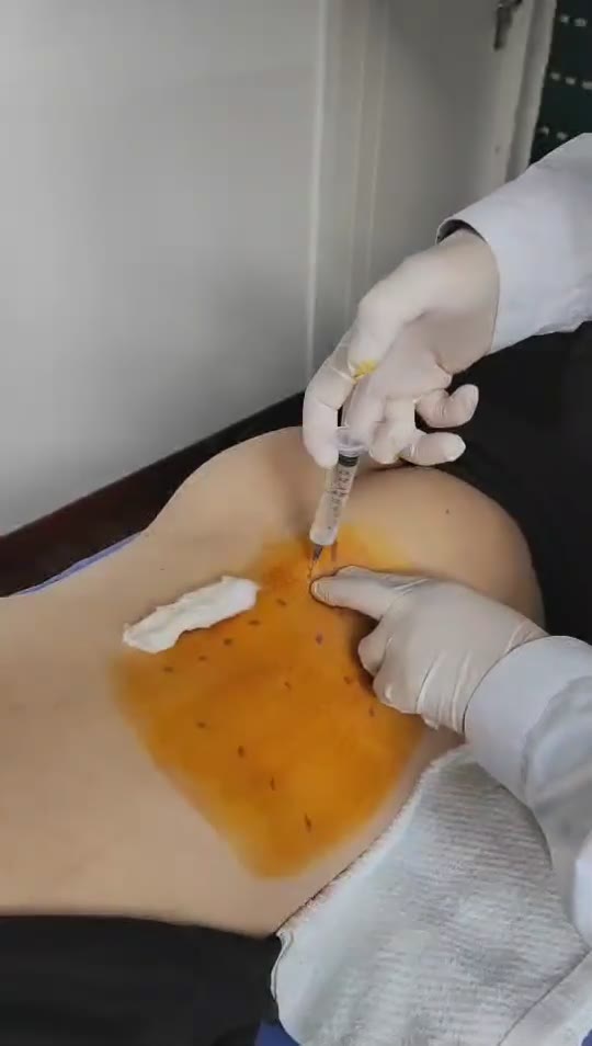 治疗长短腿视频封面