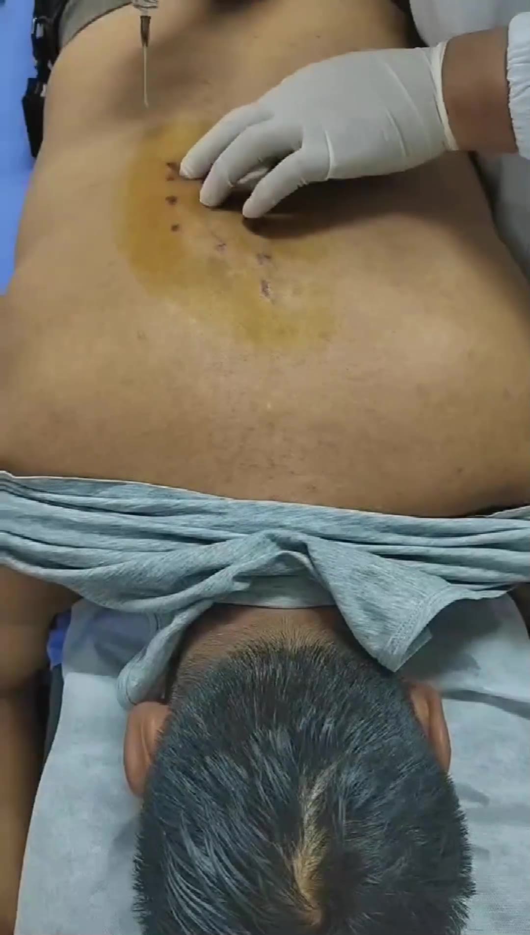 治疗顽固性失眠视频封面