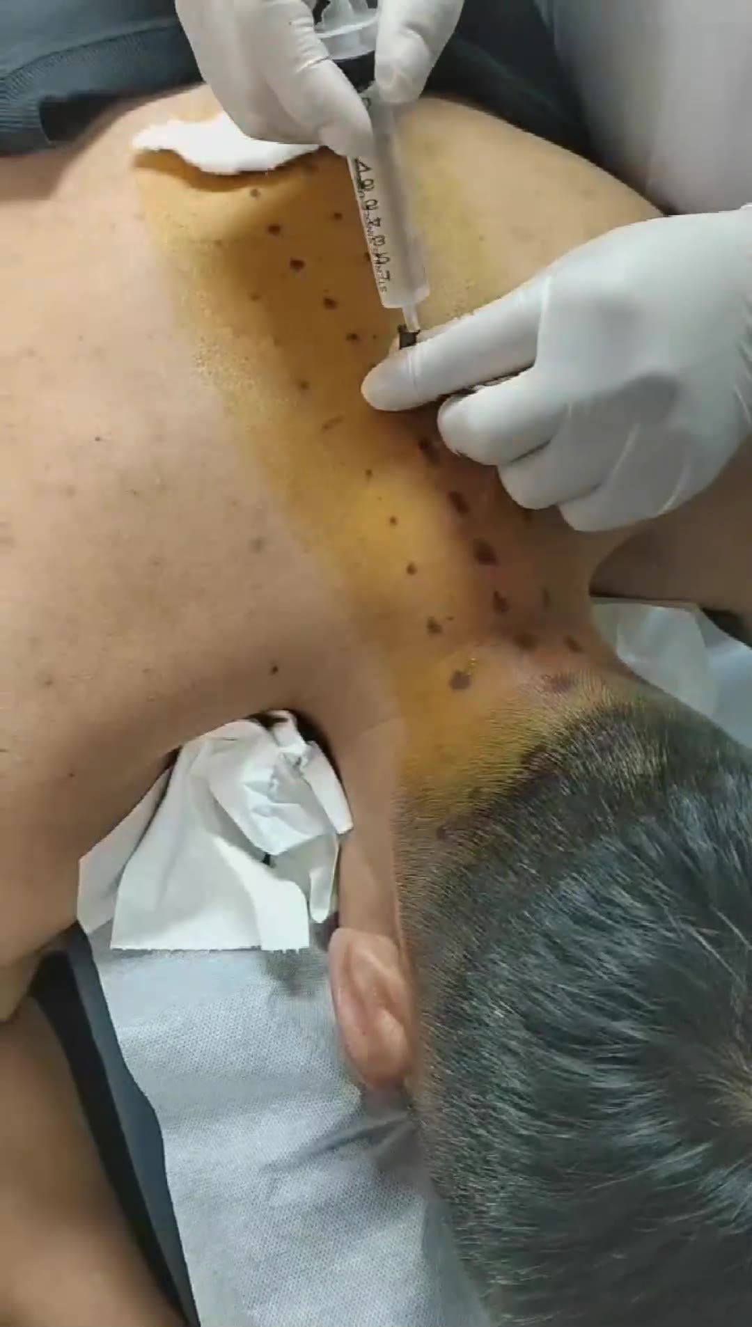 治疗顽固性富贵包_(1)视频封面
