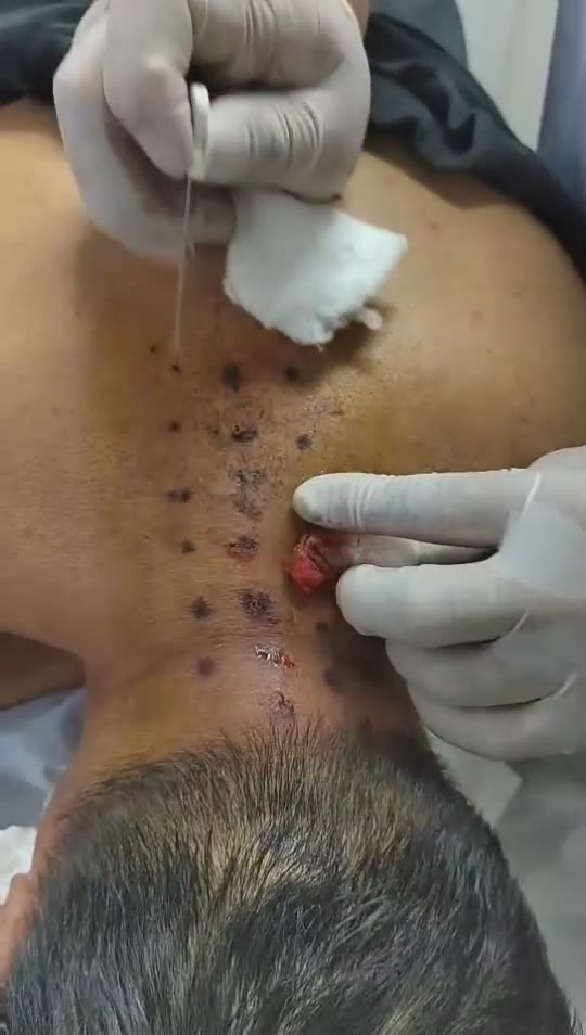 治疗颈椎管严重狭窄过电感手麻视频封面