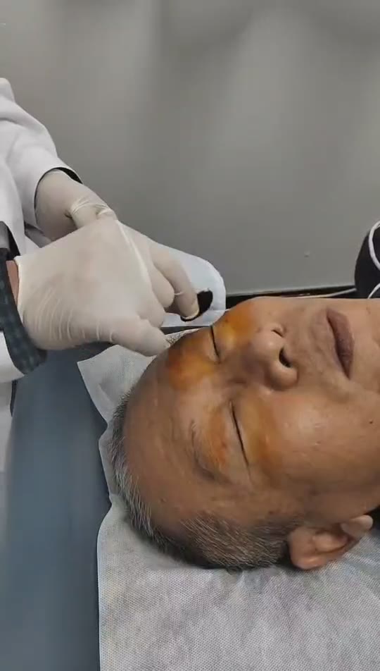 治疗黄斑前膜增厚视频封面