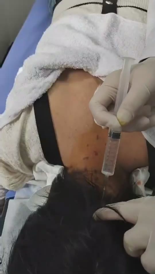 疗后脑闷胀痛视频封面