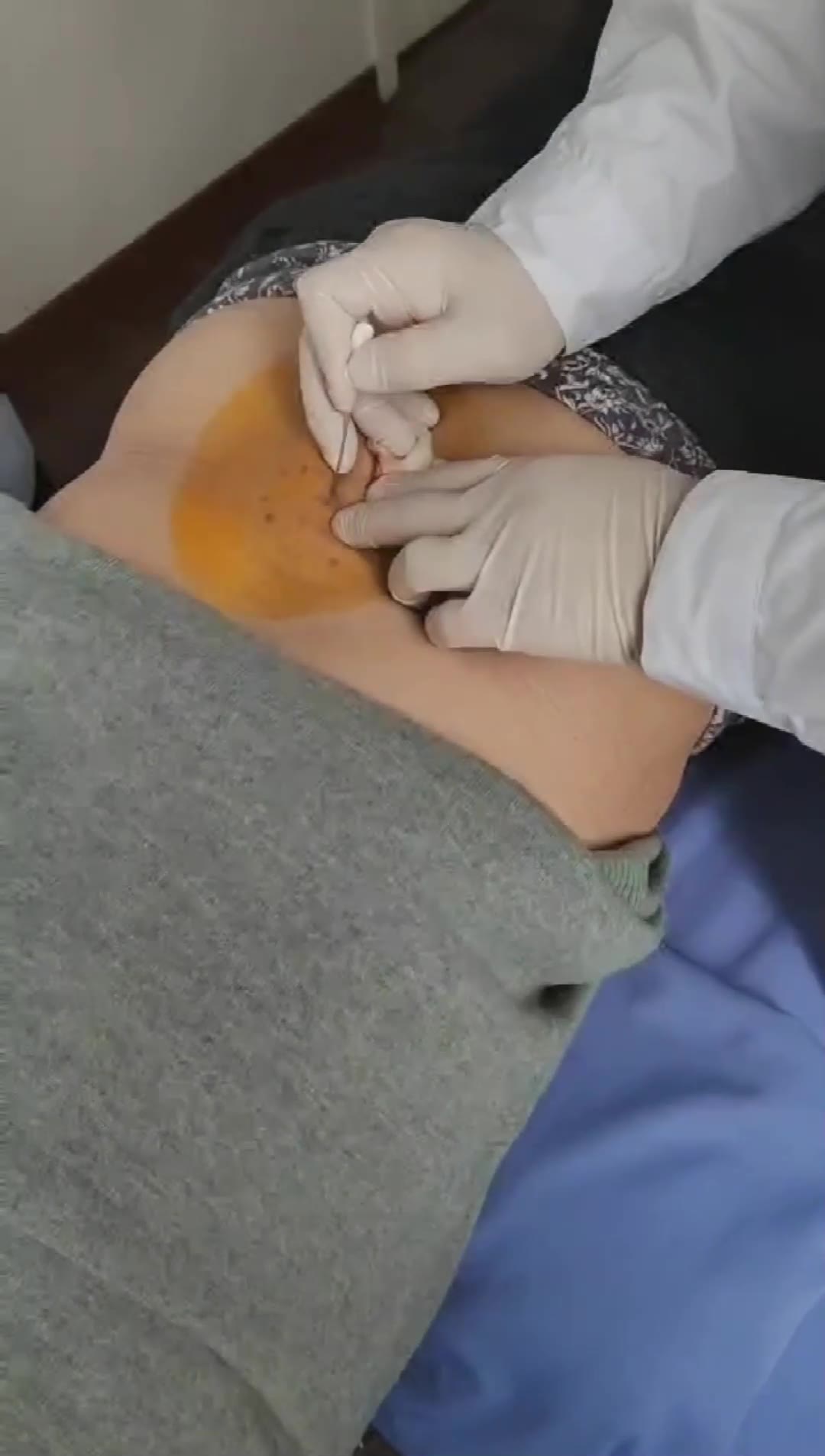 疗腰椎管狭窄视频封面