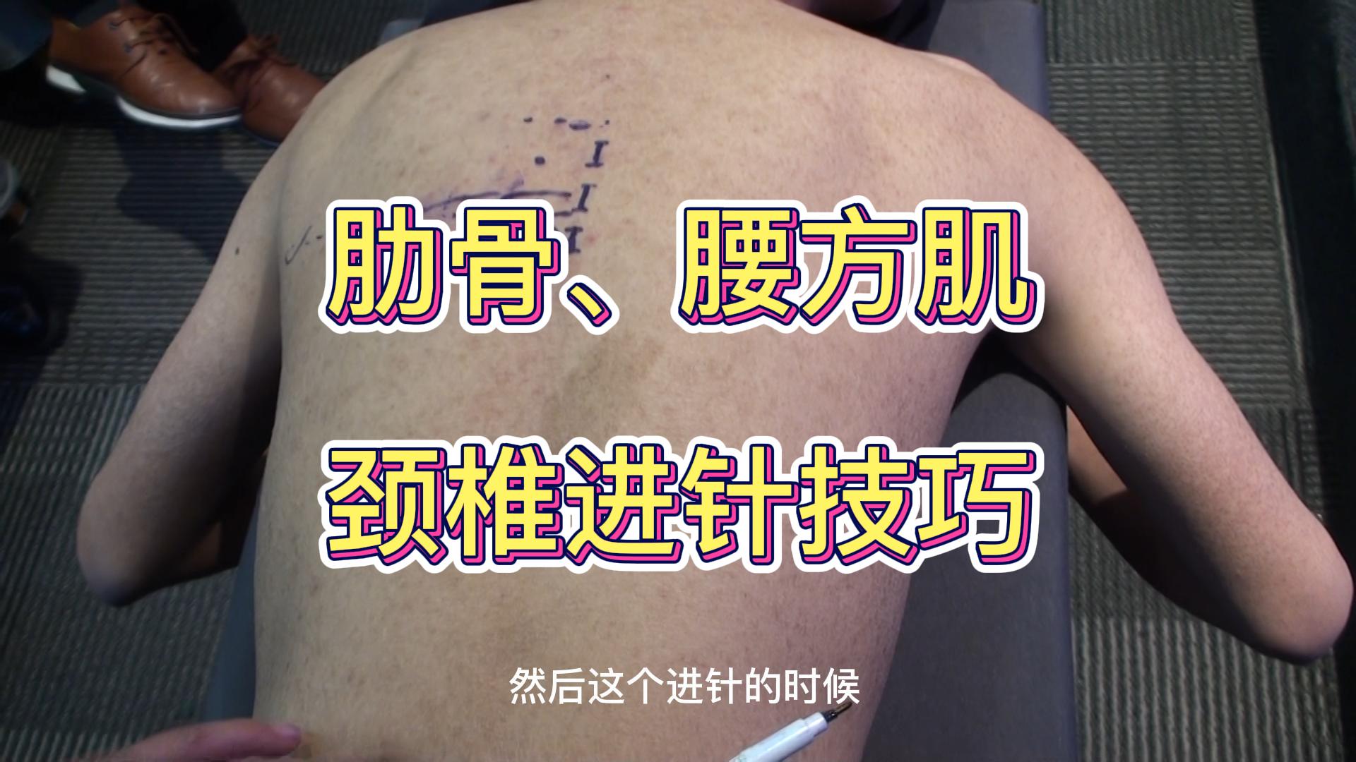 肋骨、腰方肌、颈椎进针技巧视频封面