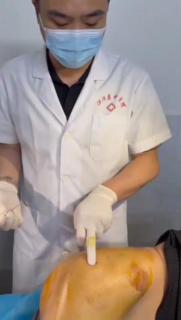 股骨头坏死的针刀治疗视频视频封面