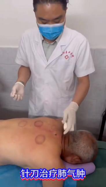 肺气肿针刀治疗视频视频封面