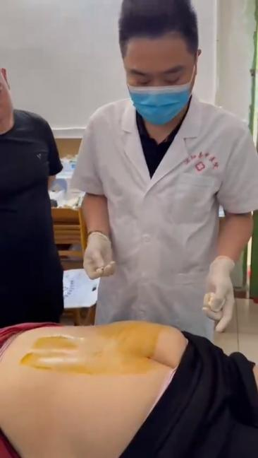 腰椎间盘突出症、侧隐窝狭窄针刀治疗视频视频封面