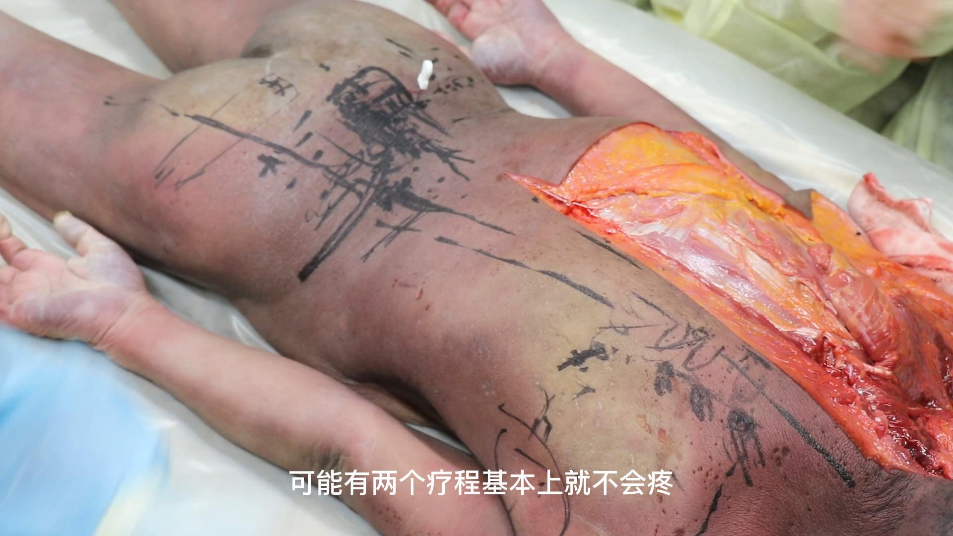 腰部疾病思路及进针技巧视频封面