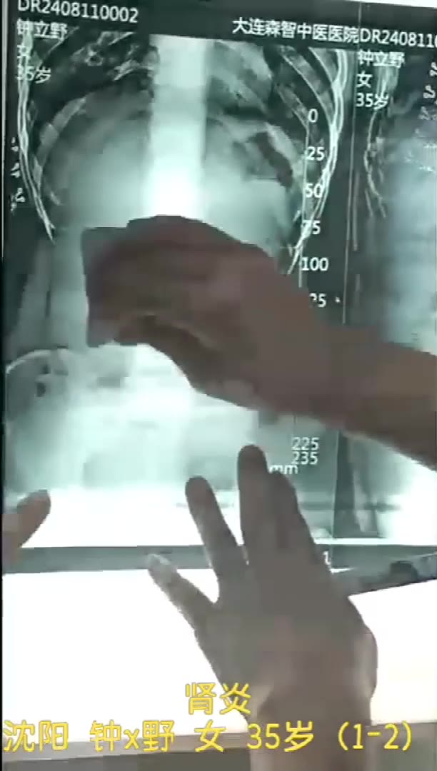 针刀治疗肾病综合征视频封面