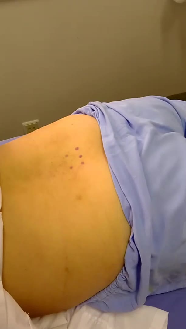 针刀治疗腰腿疼视频封面