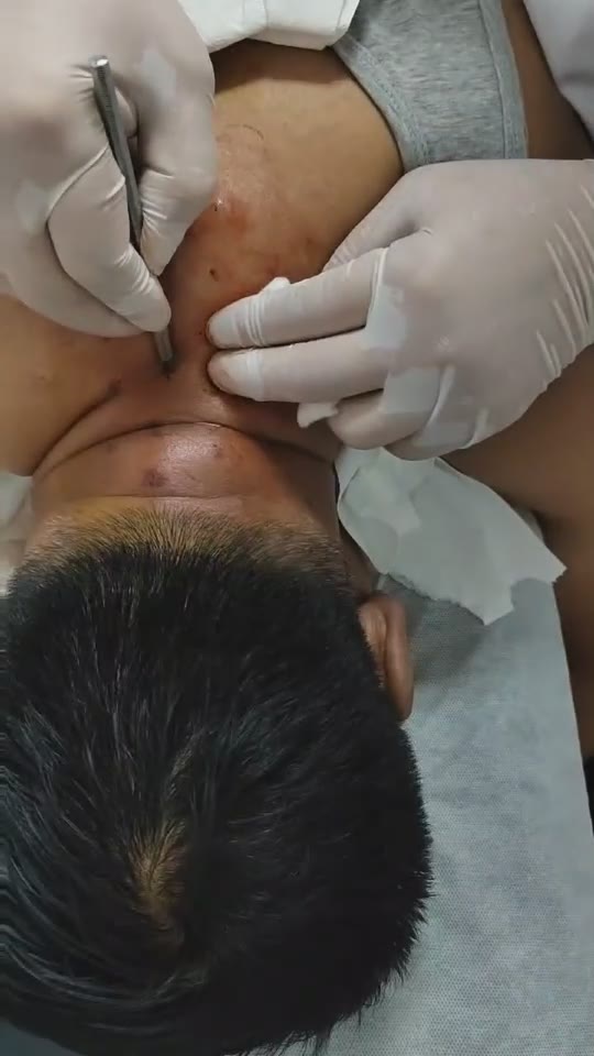 钩针治疗颈椎病视频封面