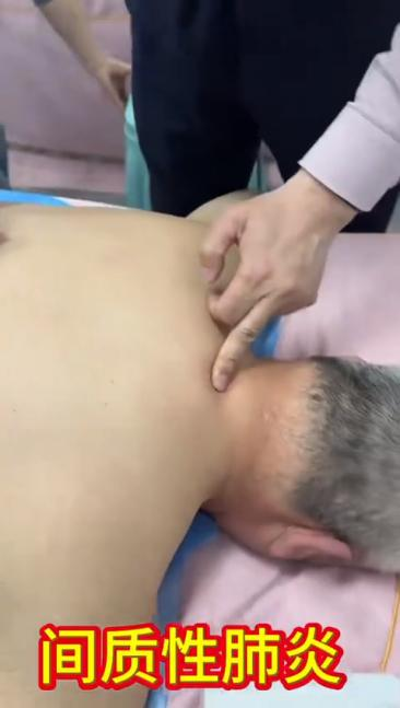 间质性肺炎针刀治疗视频视频封面