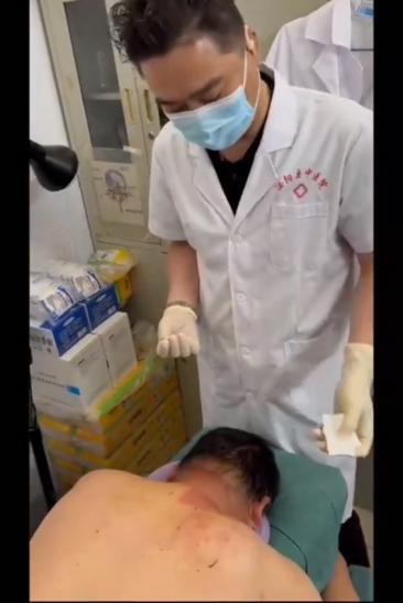 项韧带钙化、钩椎关节增生引起手麻、胀针刀治疗视频视频封面