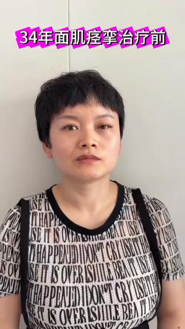 顽固性面肌痉挛针刀治疗视频视频封面