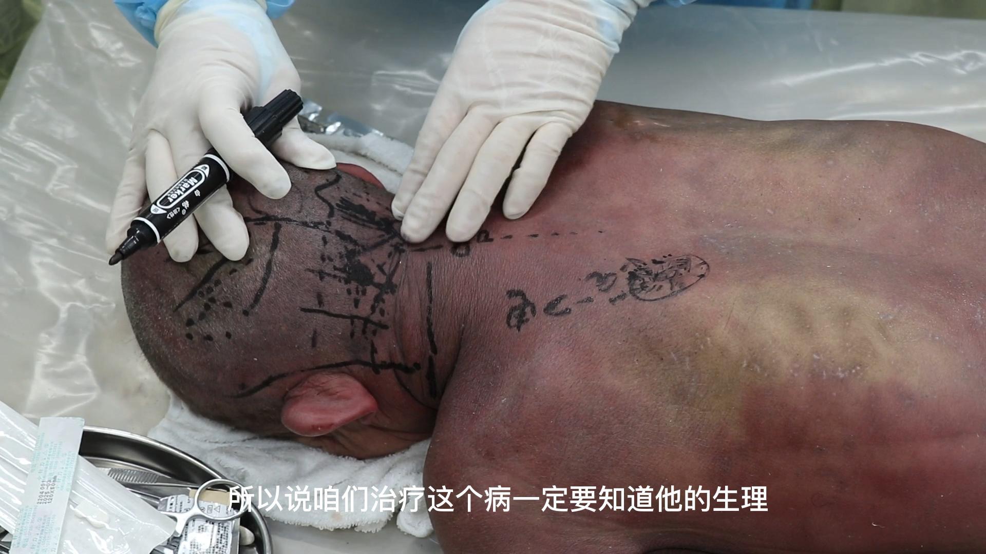 颈后部相关解剖与疾病的关系及进针技巧视频封面